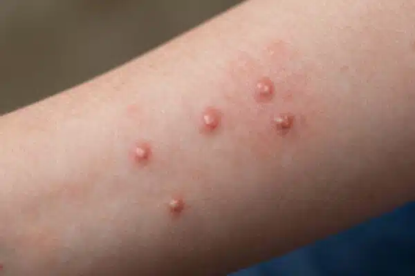 Éruption cutanée de la variole du singe sur un bras.